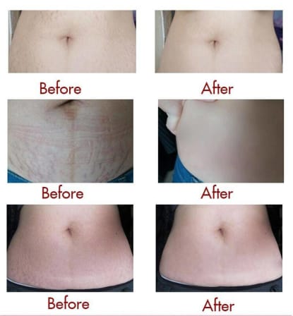 Snail Stretch Marks Cream